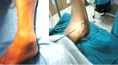 Ankle Arthroscopy Surgery, Dr. Mohit Madan