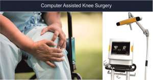 Read more about the article Computer Assisted Knee Surgery