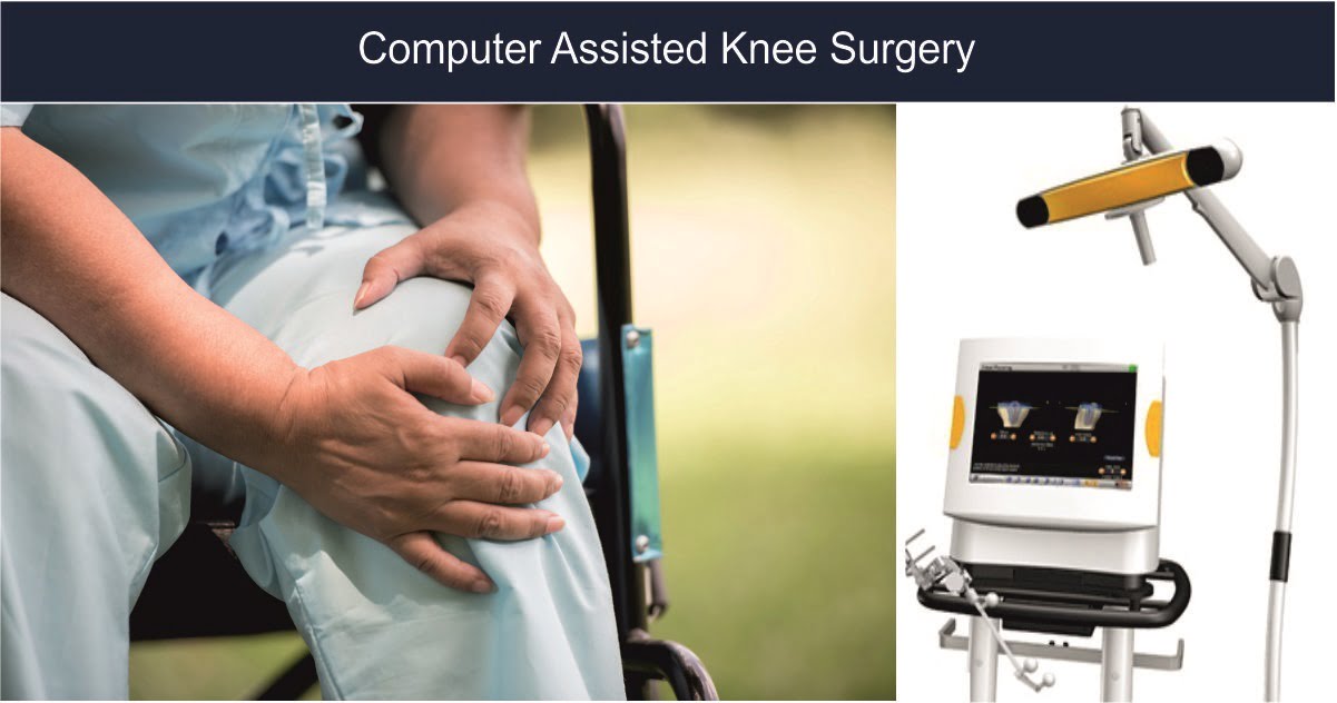 You are currently viewing Computer Assisted Knee Surgery