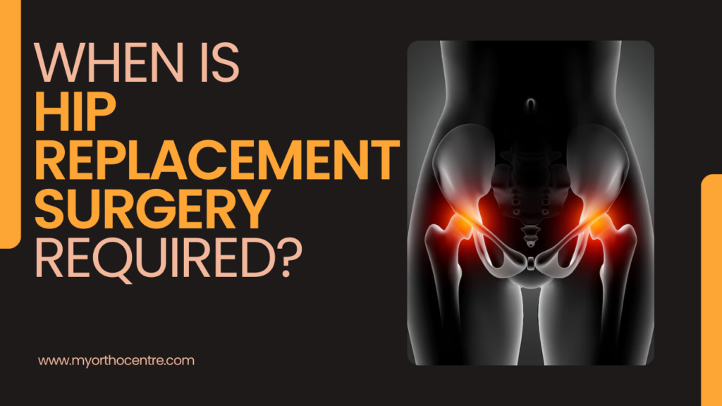 When Is Hip Replacement Surgery Required?