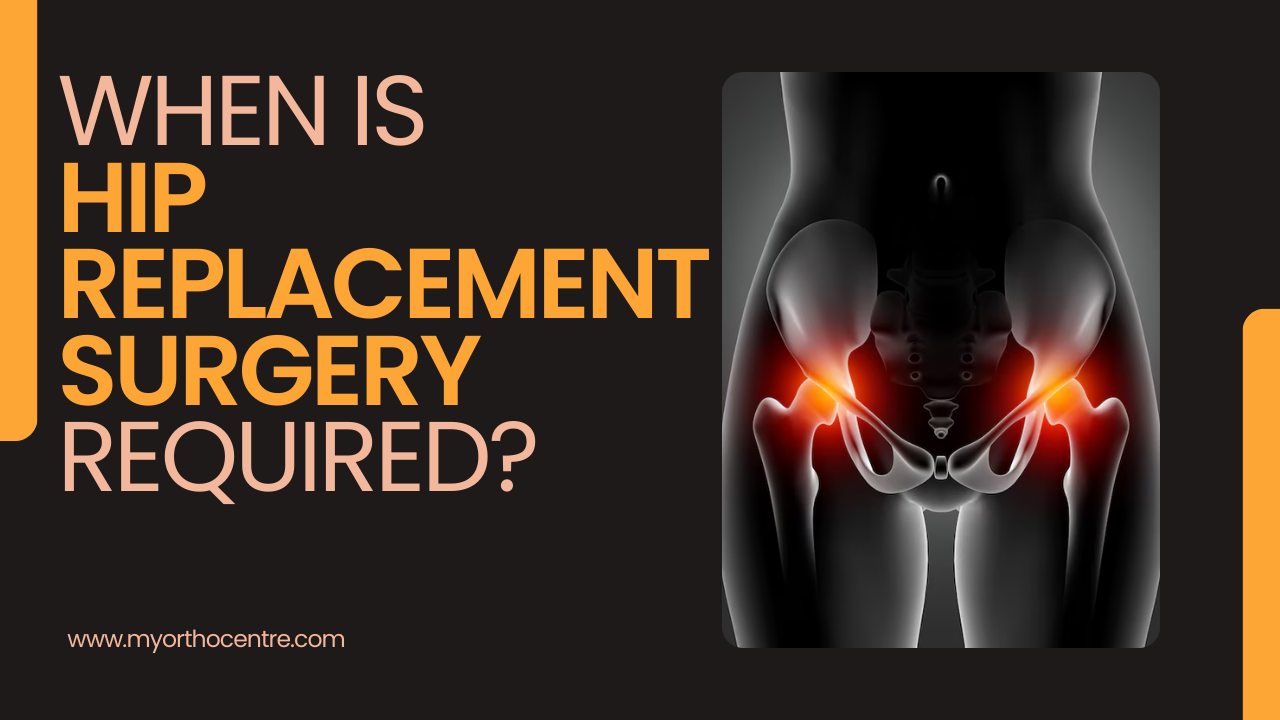 You are currently viewing When Is Hip Replacement Surgery Required?