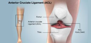 Arthroscopic ACL Reconstruction Surgery