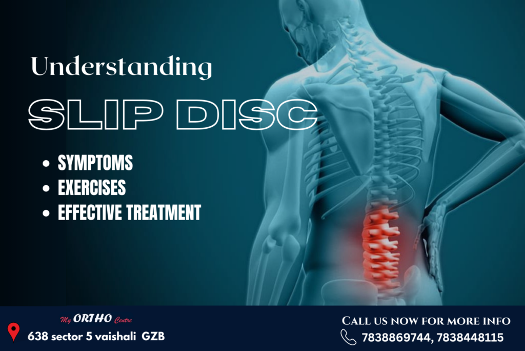 Understanding Slip Disc: Symptoms, Exercises, and Effective Treatment Options